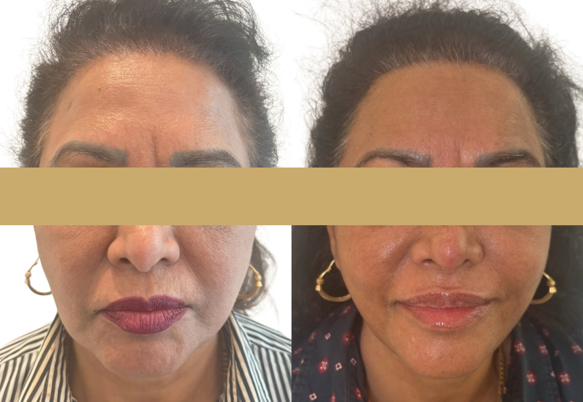 endolift